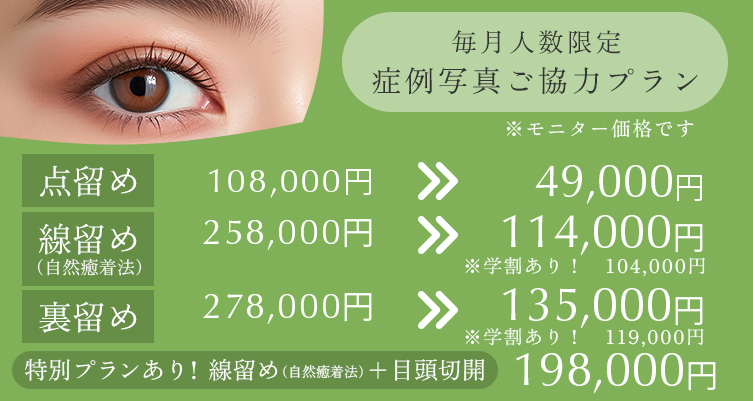 毎月人数限定 症例写真ご協力プラン 点留め 108,000円→49,000円、線留め 258,000円→114,000円(学割あり:104,000円)、 裏留め 278,000円→135,000円(学割あり:119,000円)、特別プランあり!線留め(自然癒着法)+目頭切開 198,000円